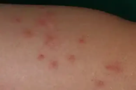 トコジラミに刺された跡