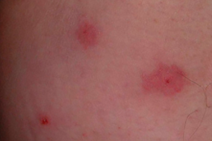 ダニに刺された跡