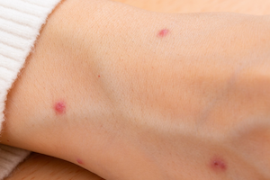 ノミに刺された跡