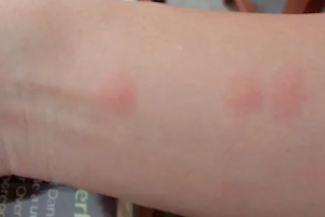 トコジラミに刺された跡